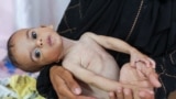 ISRAEL-PALESTINIANS/GAZA-HUNGER