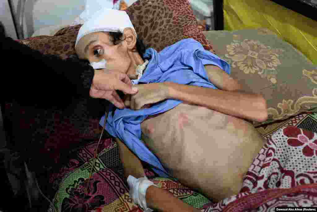 În imagine – băiatul palestinian Mosab Al-Debs, în vârstă de 14 ani, care, potrivit medicilor, este subnutrit. El este întins pe un pat la spitalul Al-Shifa din orașul Gaza, 22 iulie 2025